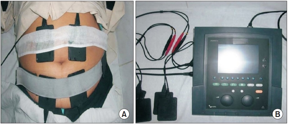 Tratamientos electroestimulación