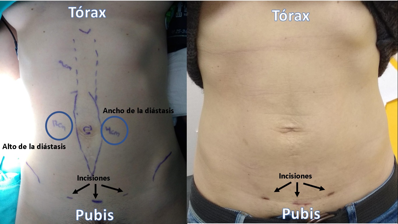 CIRUGÍA MÍNIMAMENTE INVASIVA – Sin Diástasis Abdominal