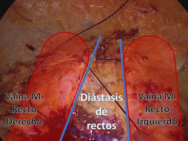 Hoy me opero, ¿qué va a ocurrir?