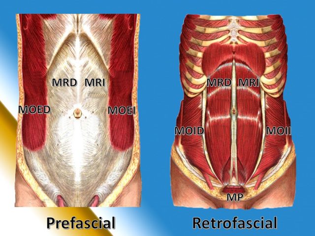 Musculo recto pared abdominal