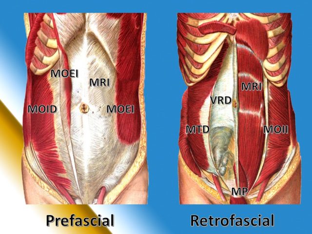 musculo recto pared abdominal