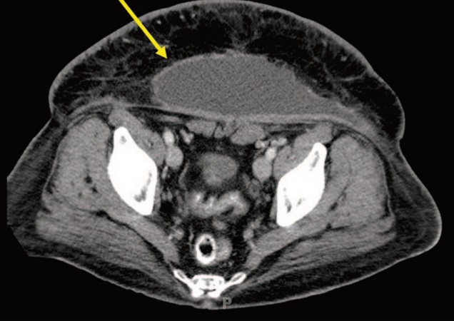 aspecto seroma subcutaneo